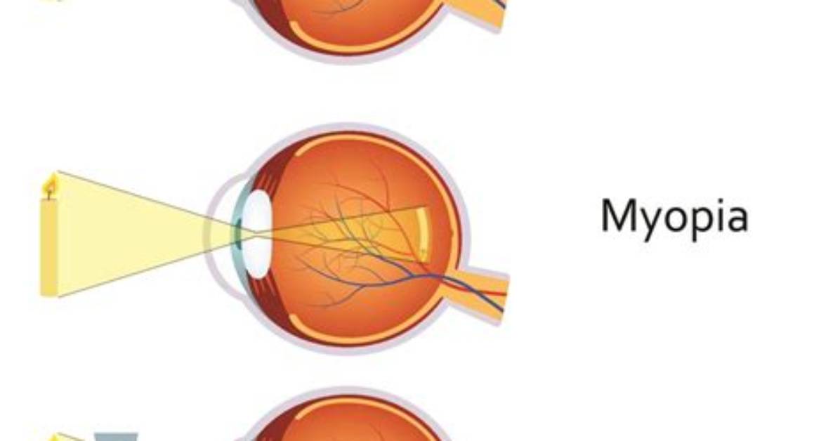 Can Myopia Cause Squint?