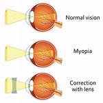 Can Myopia Cause Squint?