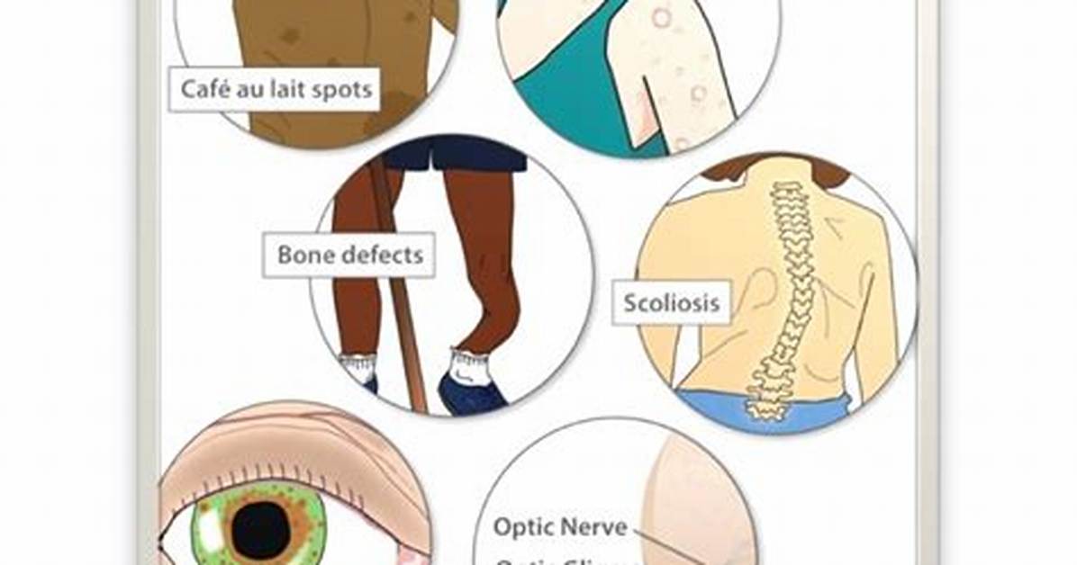 Can Neurofibromatosis Cause Insomnia?
