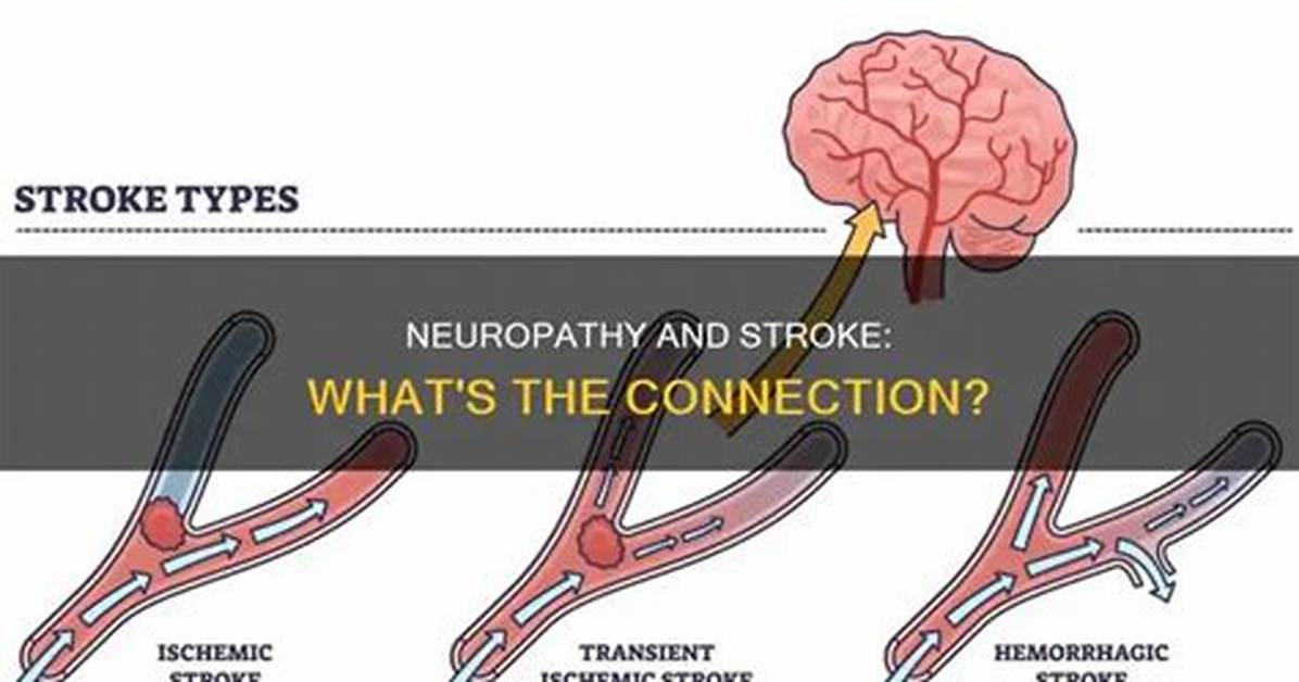 Can Neuropathy Cause a Stroke?
