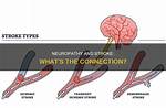 Can Neuropathy Cause a Stroke?