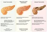 Can Pancreatitis Cause Urinary Problems?