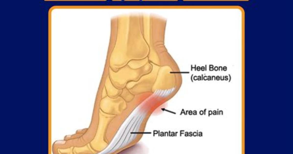 Can Plantar Fasciitis Come on Suddenly?