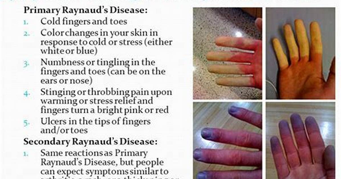 Can Raynaud's Cause Hair Loss?