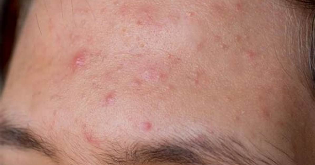 Can Sweat Cause Pimples?