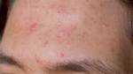Can Sweat Cause Pimples?