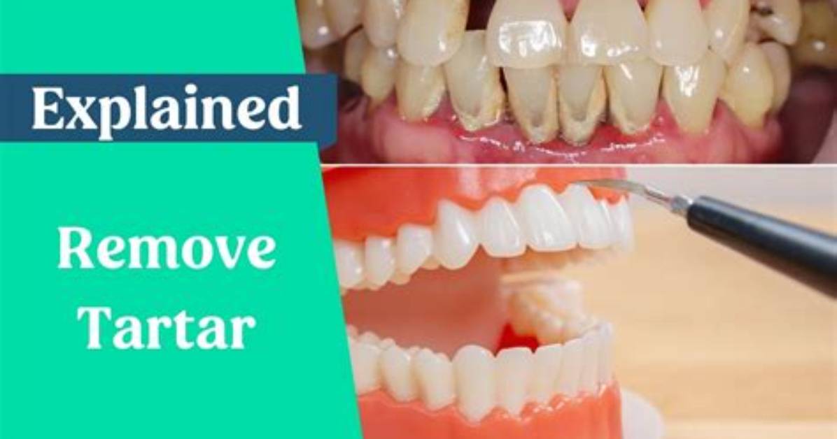 Can Tartar Be Removed Without Dentist?