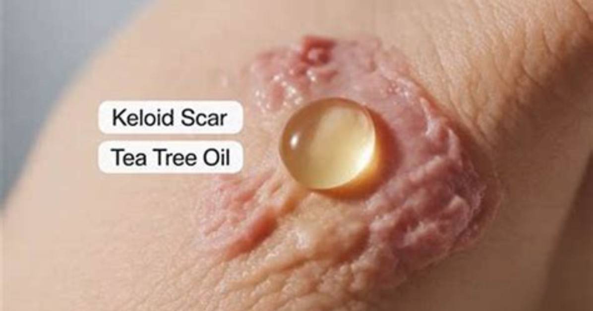Can Tea Tree Oil Help Keloids?