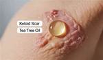 Can Tea Tree Oil Help Keloids?