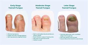 Can Toenail Fungus Affect Your Liver?