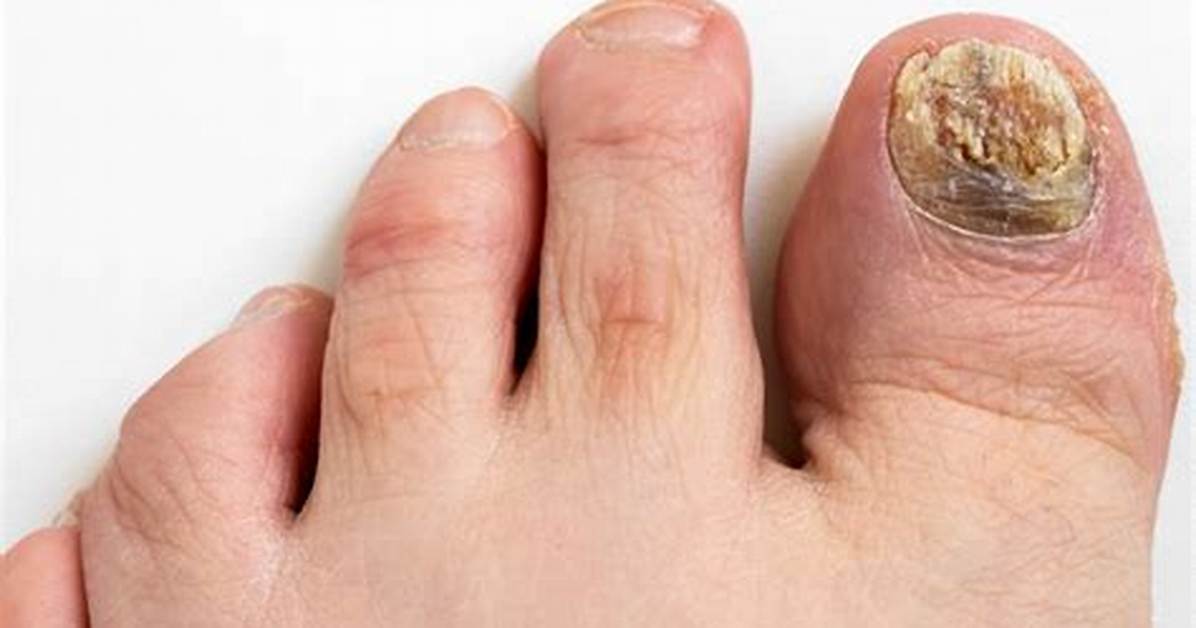 Can Toenail Fungus Cause Numb Toes?