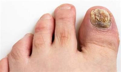 Can Toenail Fungus Cause Numb Toes?