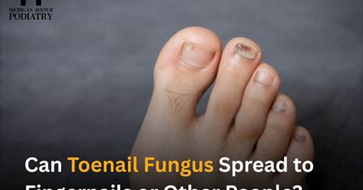 Can Toenail Fungus Spread to Skin?