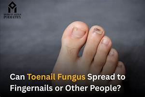 Can Toenail Fungus Spread to Skin?