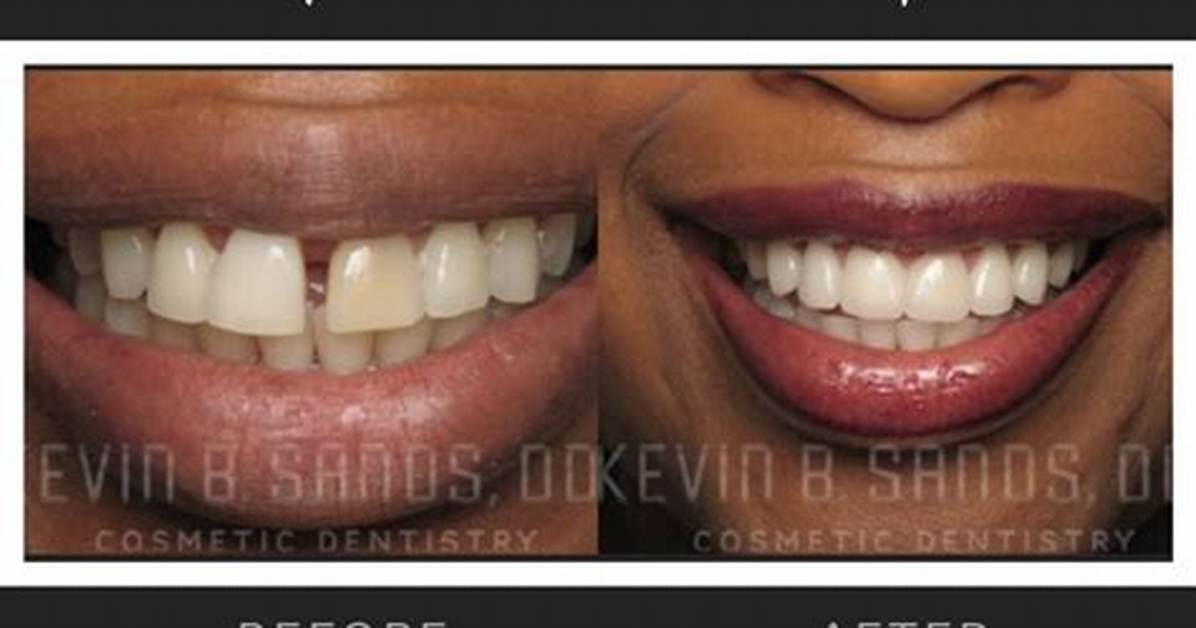 Can Veneers Make Small Teeth Bigger?