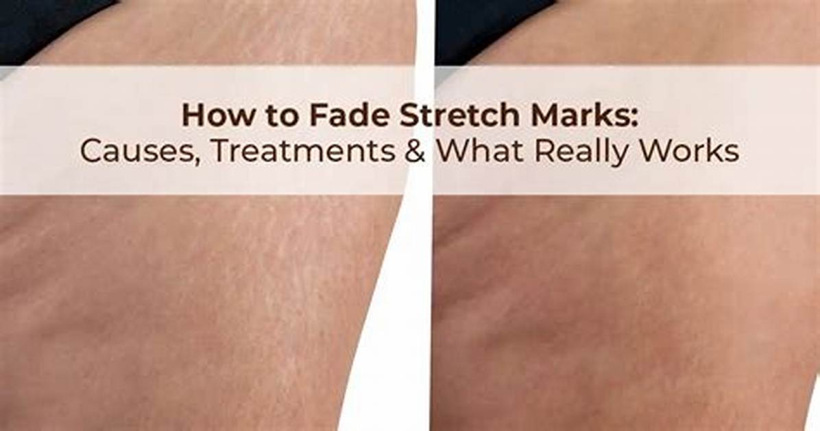 Can White Stretch Marks Fade?