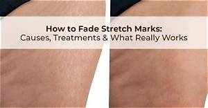 Can White Stretch Marks Fade?