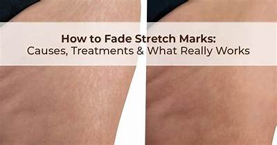 Can White Stretch Marks Fade?