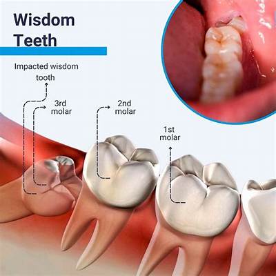 Can Wisdom Teeth Rot in Your Mouth?