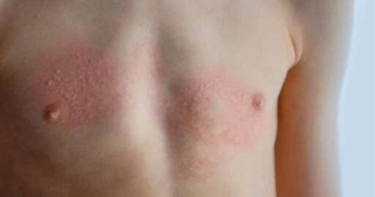Can You Be Allergic to Titanium Dioxide?