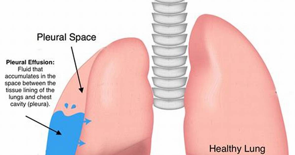 Can You Die from Pleural Effusion?