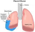 Can You Die from Pleural Effusion?