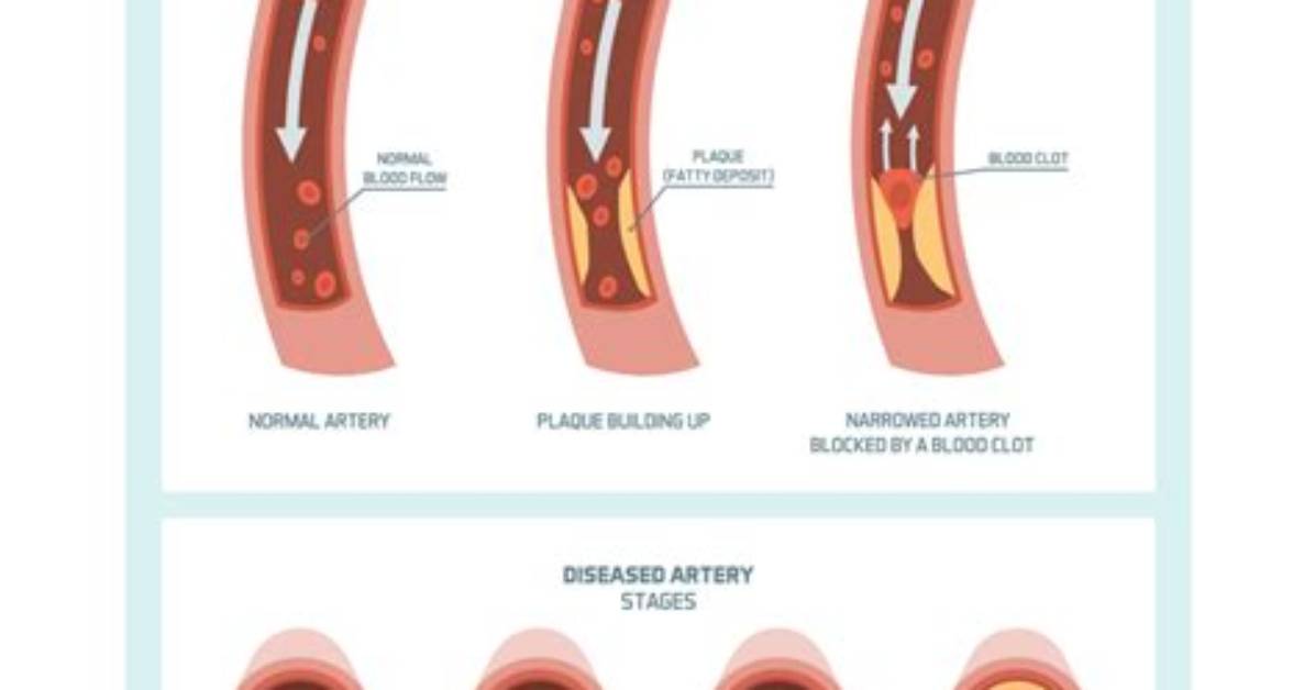 Can You Feel a Blocked Artery?