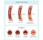 Can You Feel a Blocked Artery?