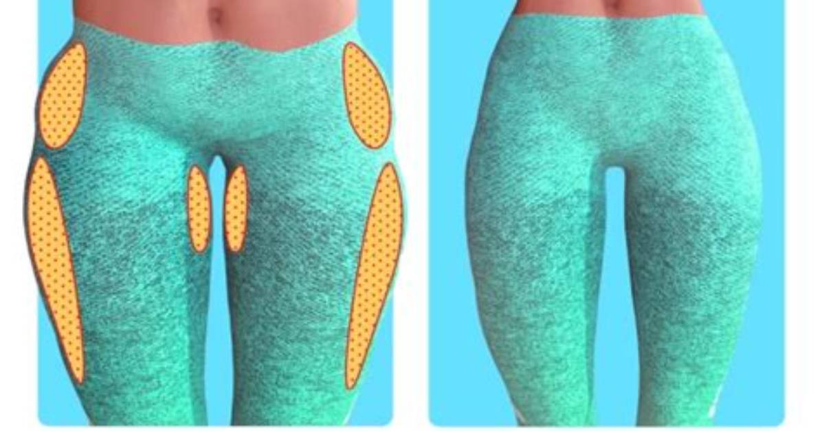 Can You Fill in Hip Dips?