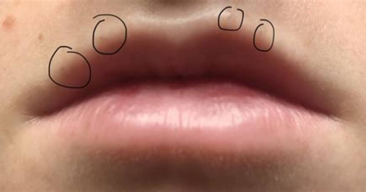 Can You Get Blackhead on Lip Line?