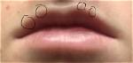 Can You Get Blackhead on Lip Line?