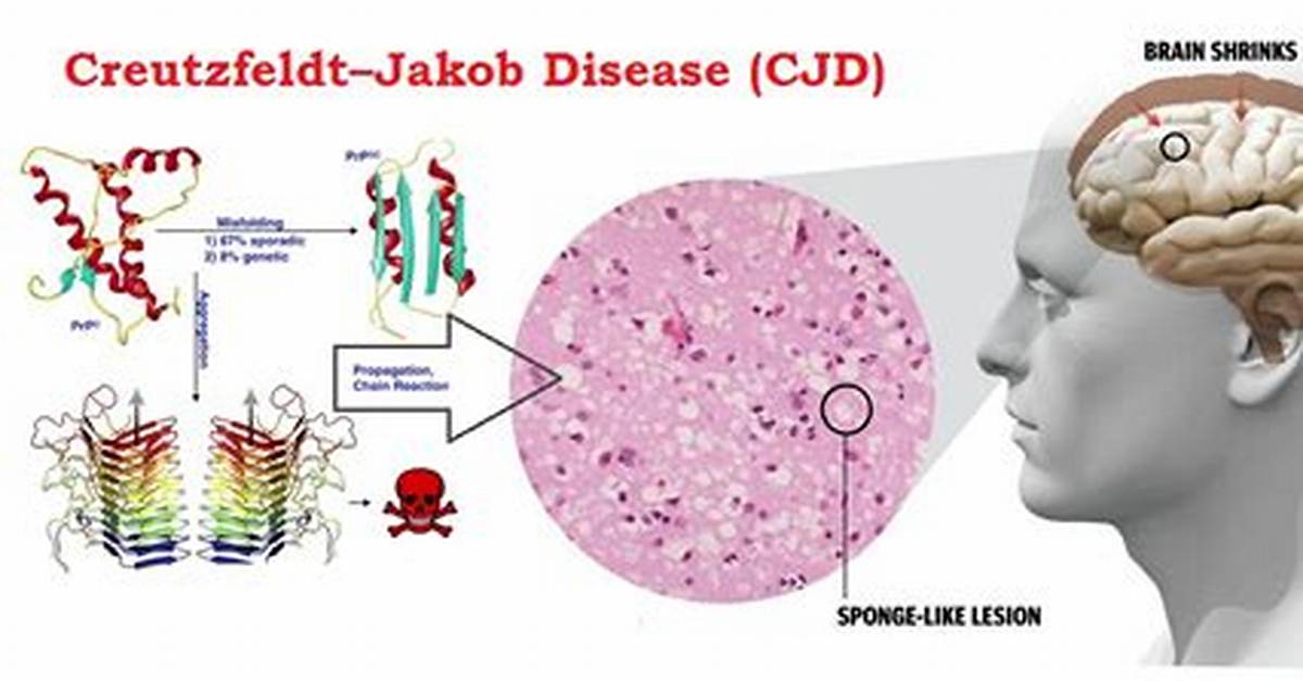 Can You Get Cjd from Pork?