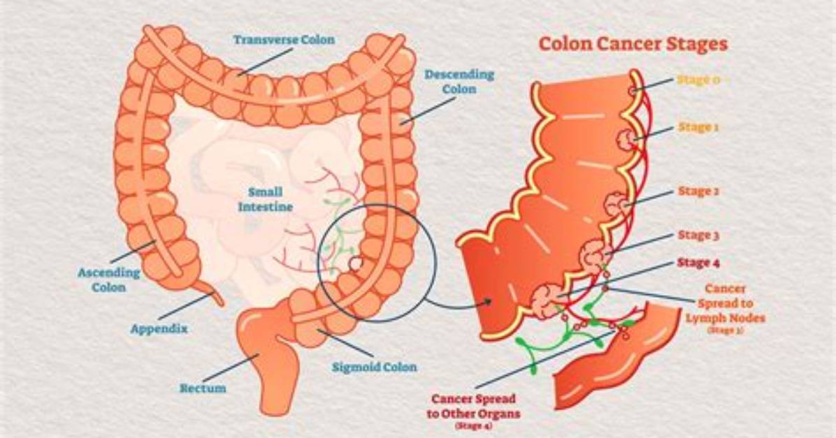Can You Get Colon Cancer 3 Year's After Colonoscopy?