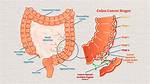Can You Get Colon Cancer 3 Year's After Colonoscopy?