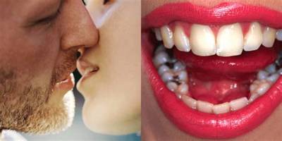 Can You Give Cavities by Kissing?