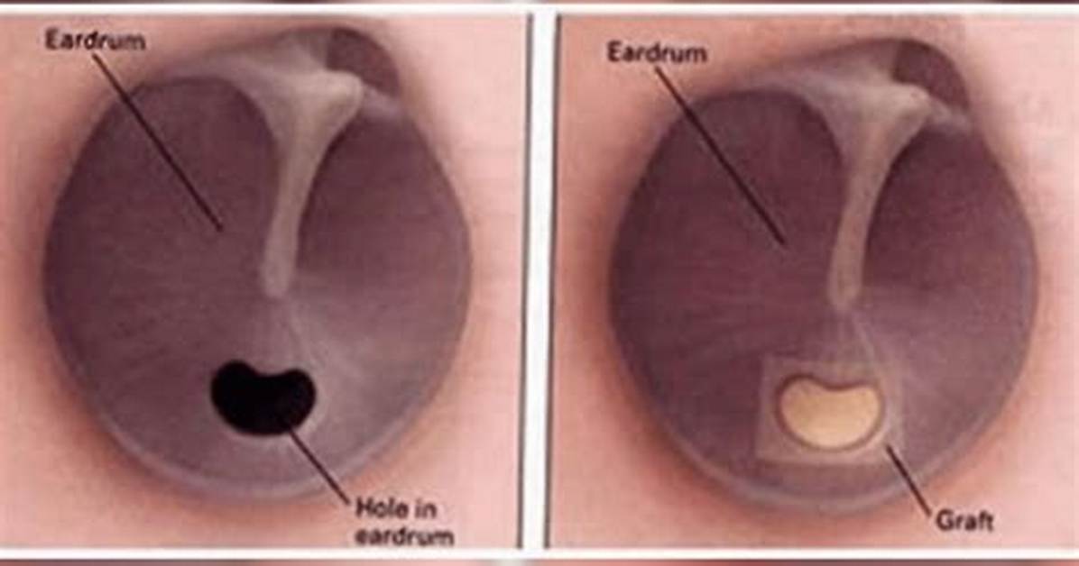 Can You Live with a Perforated Eardrum?