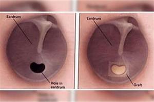 Can You Live with a Perforated Eardrum?