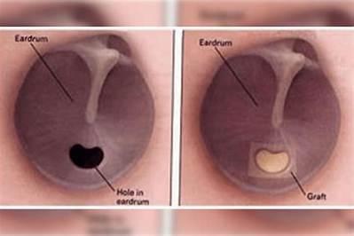 Can You Live with a Perforated Eardrum?