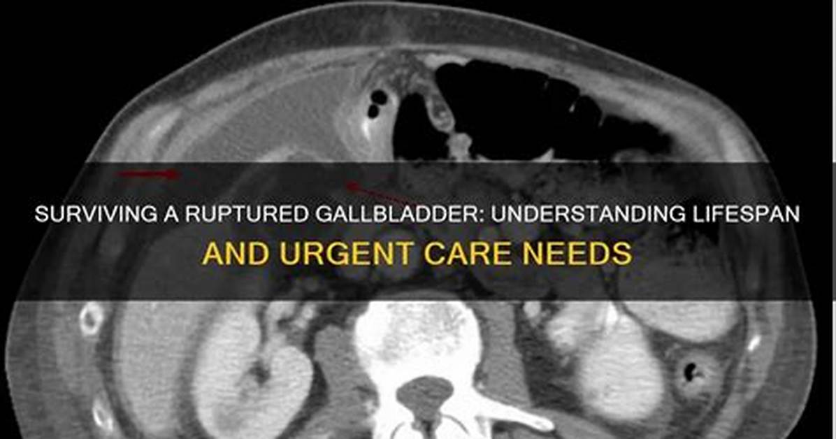 Can You Live with a Ruptured Gallbladder?