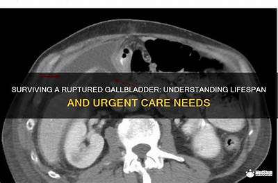 Can You Live with a Ruptured Gallbladder?
