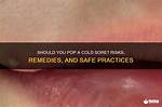 Can You Pop a Cold Sore Safely? Everything You Need to Know