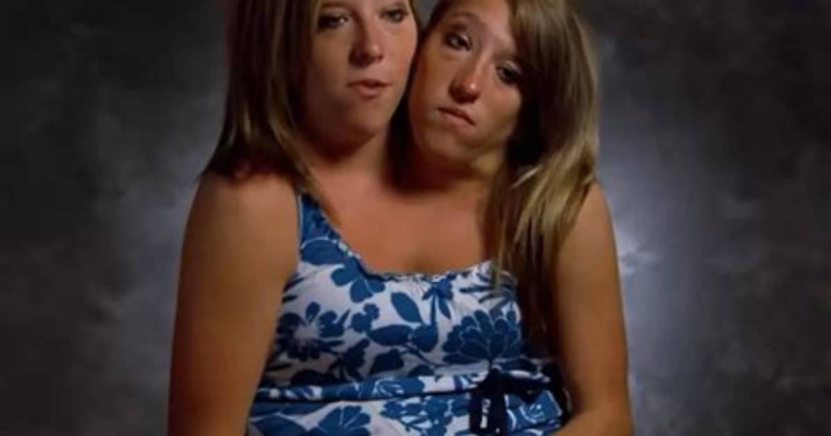 Can You Tell If Twins Are Conjoined Before Birth?