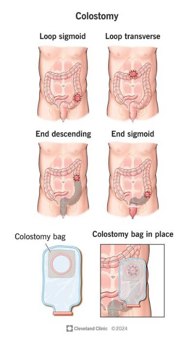 Can You Walk After Colostomy Surgery?