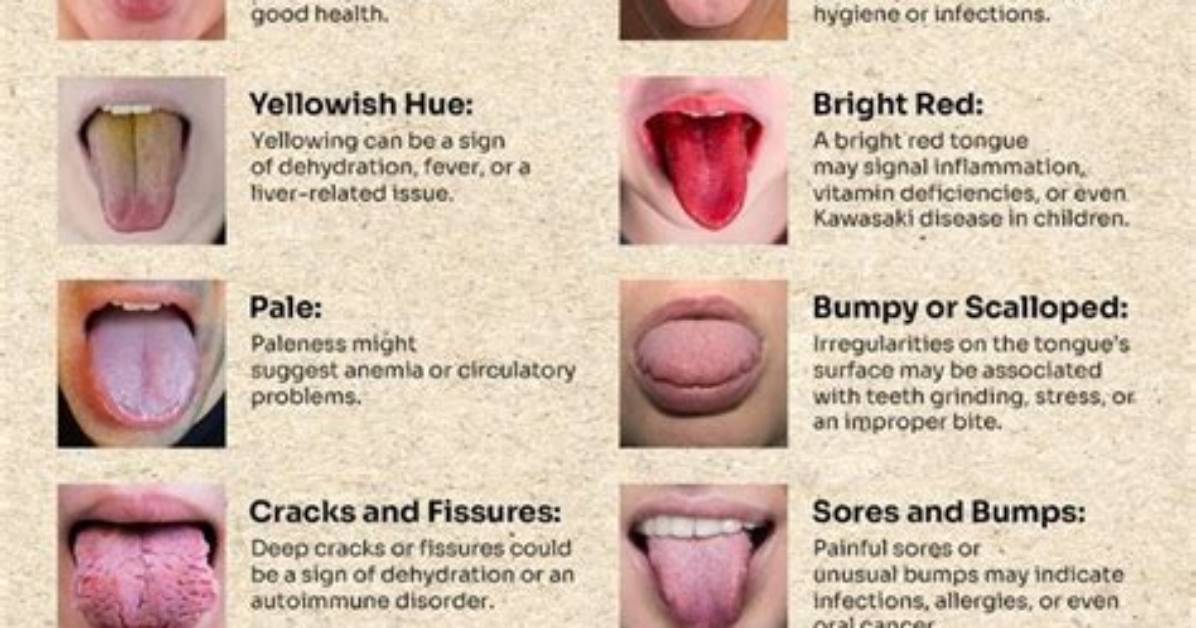 Can Your Tongue Show Signs of Illness?