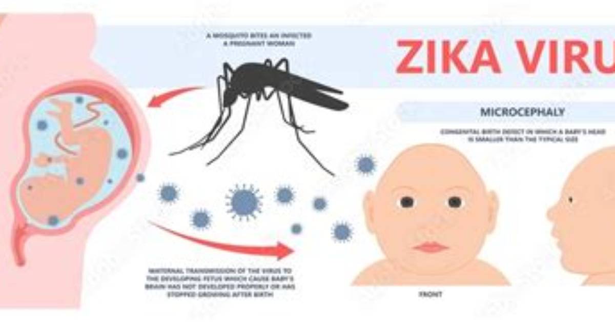 Can Zika Cause Autism?