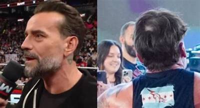 Cm Punk Hair Transplant: the Ultimate Guide to Restoring Your Confidence