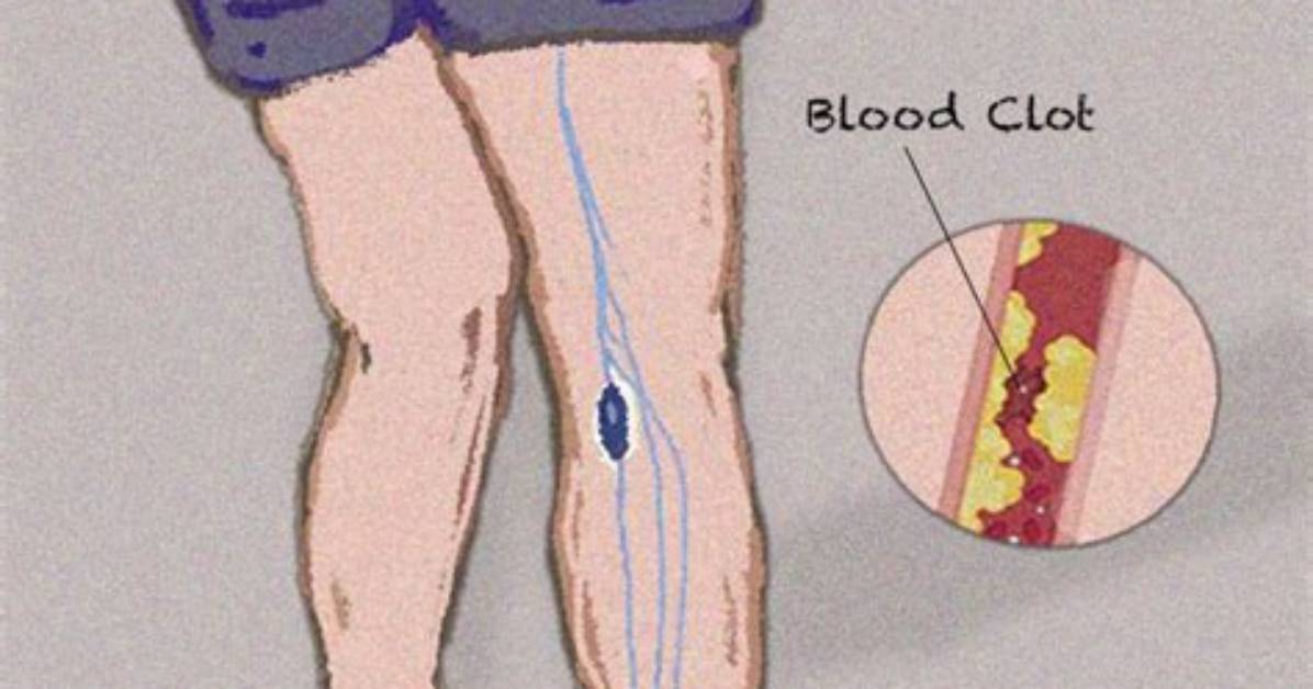 Could Knee Pain Be a Blood Clot?