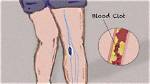 Could Knee Pain Be a Blood Clot?