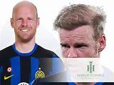 Davy Klaassen Have No Hair Looks- Does He Have Alopecia or Albinism?