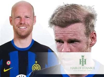 Davy Klaassen Have No Hair Looks- Does He Have Alopecia or Albinism?